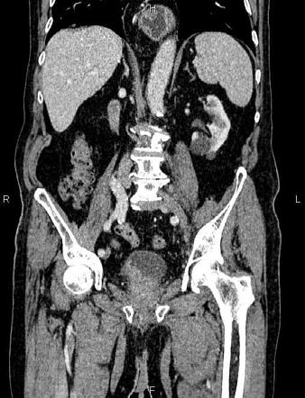 Urinary bladder cancer | Radiology Case | Radiopaedia.org