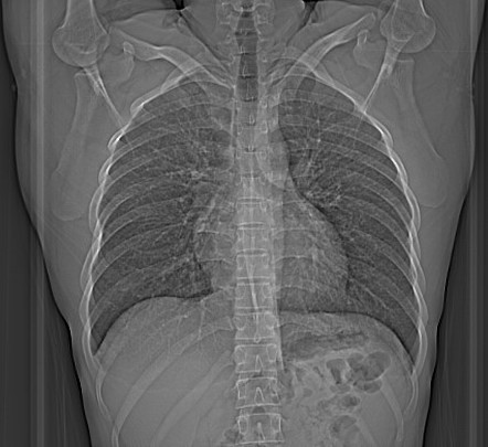 Tropical pulmonary eosinophilia | Radiology Reference Article ...