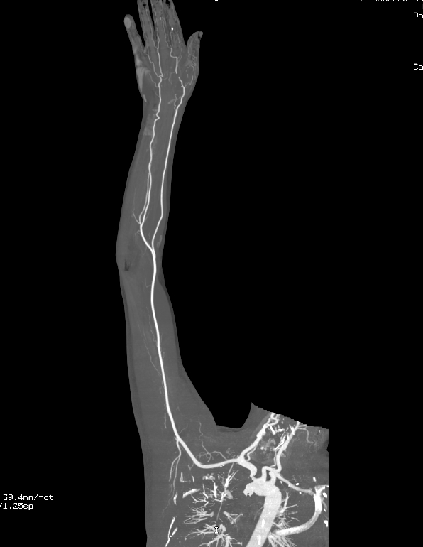 Normal CT upper limb angiography | Image | Radiopaedia.org