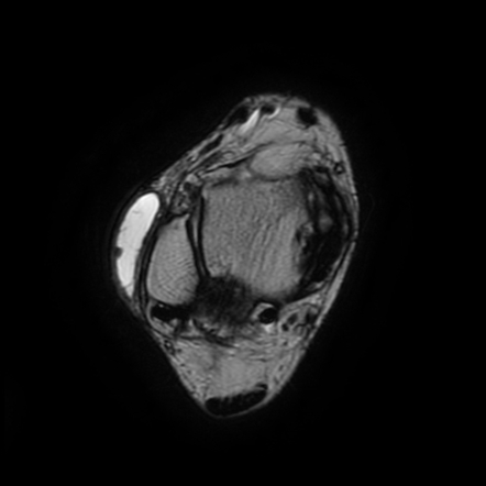 Lateral Malleolus Bursa 