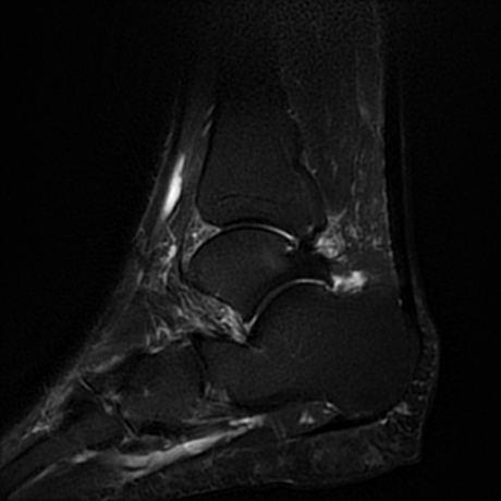 Lateral malleolus bursa | Image | Radiopaedia.org