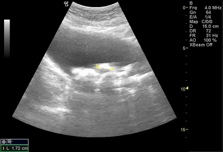 Urinary bladder stones | Radiology Case | Radiopaedia.org