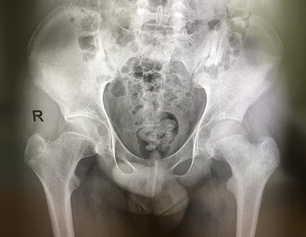 Chondroblastic osteosarcoma - proximal femur | Radiology Case ...