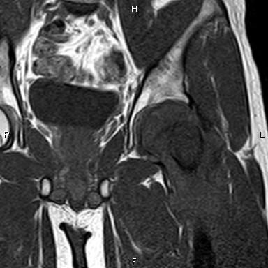 Chondroblastic osteosarcoma - proximal femur | Image | Radiopaedia.org