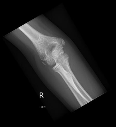 Elbow series (paediatric) | Radiology Reference Article | Radiopaedia.org