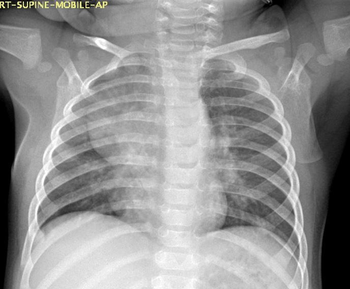 Thymus gland - normal | Image | Radiopaedia.org