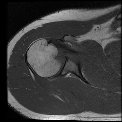 Reverse Hill-Sachs and Bankart lesion | Image | Radiopaedia.org