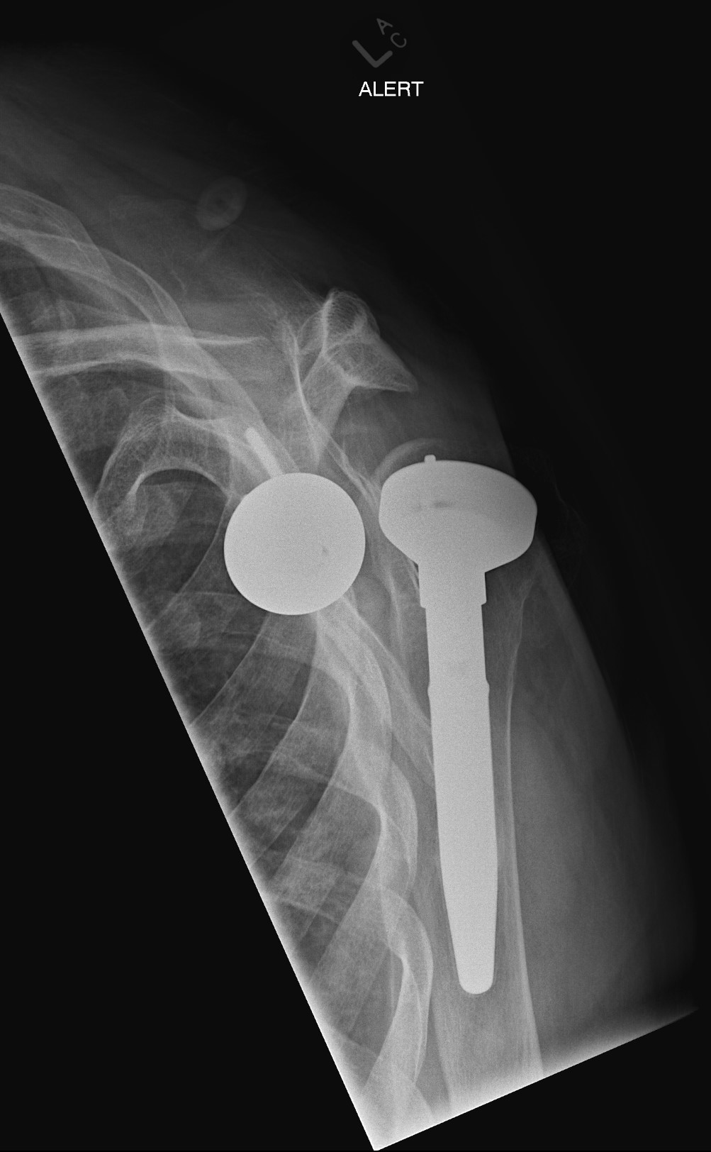 Dislocated Reverse Total Shoulder Arthroplasty Image 7463