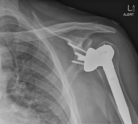 Reverse total shoulder arthroplasty | Radiology Reference Article ...