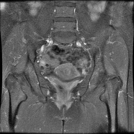 Wk 3 L2 Endometrial Polyp With Coronal Us Reformat