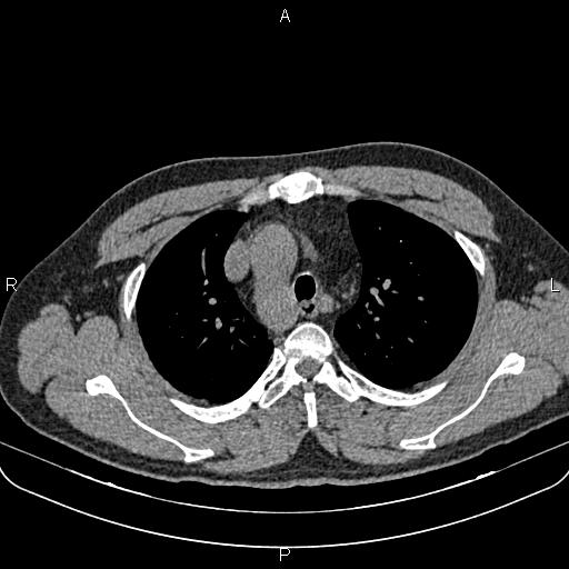 Right sided aortic arch | Image | Radiopaedia.org