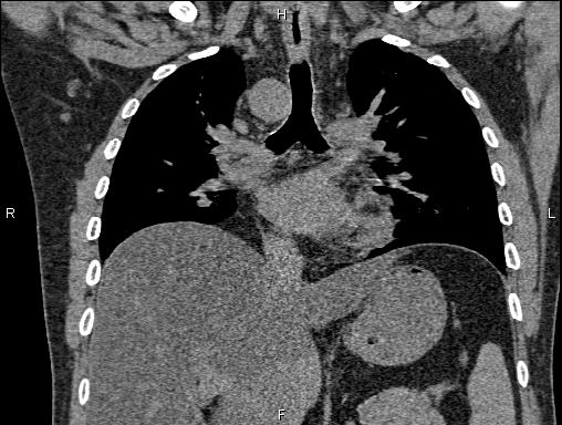 Right sided aortic arch | Image | Radiopaedia.org