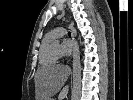 Right sided aortic arch | Image | Radiopaedia.org