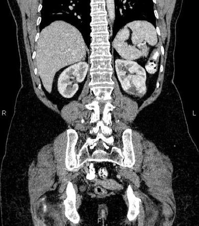 Renal cell carcinoma | Image | Radiopaedia.org