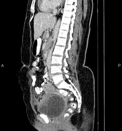 Transitional cell carcinoma (urinary bladder) | Radiology Reference ...