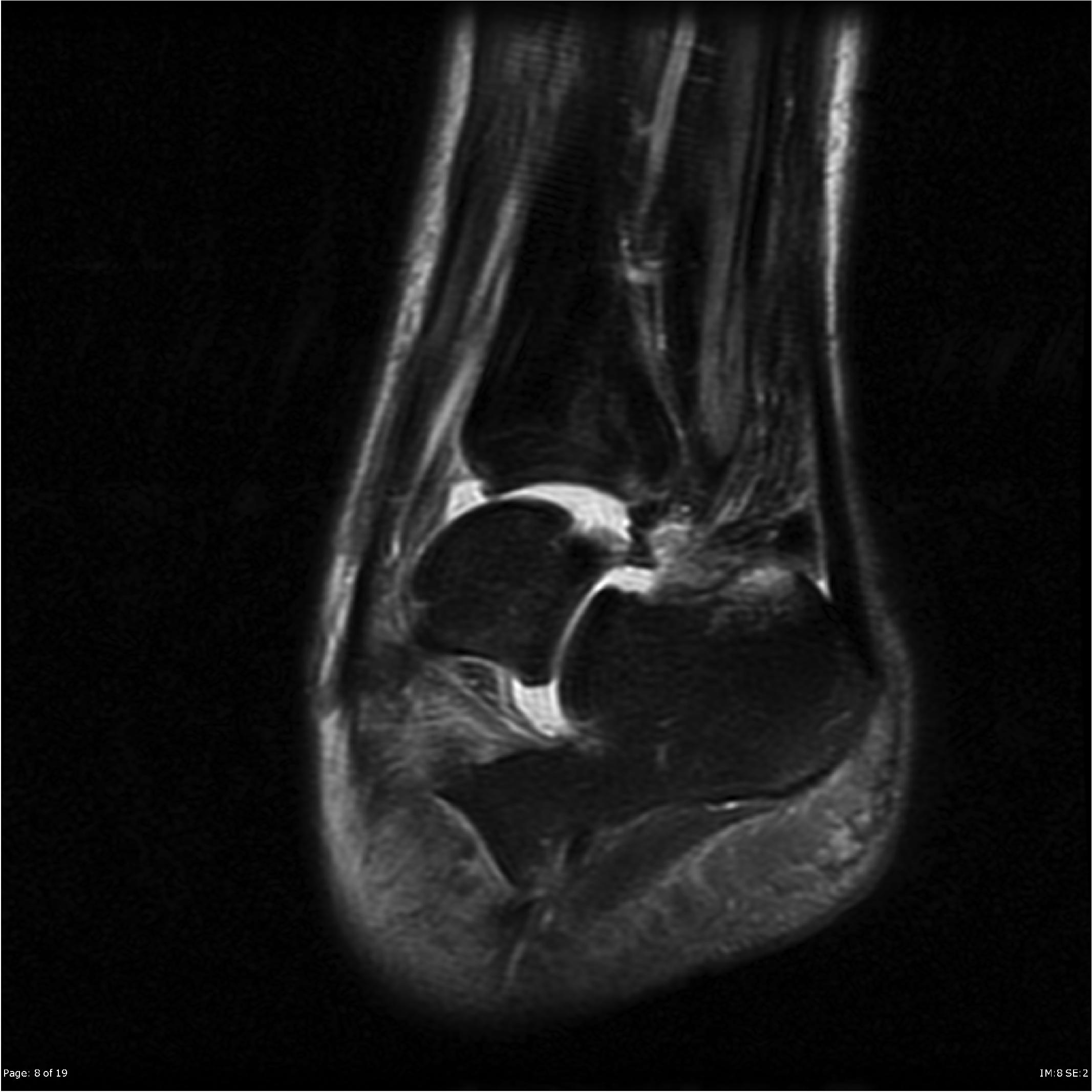 Chronic Ankle Pain And Inflammation Following Atfl Rupture