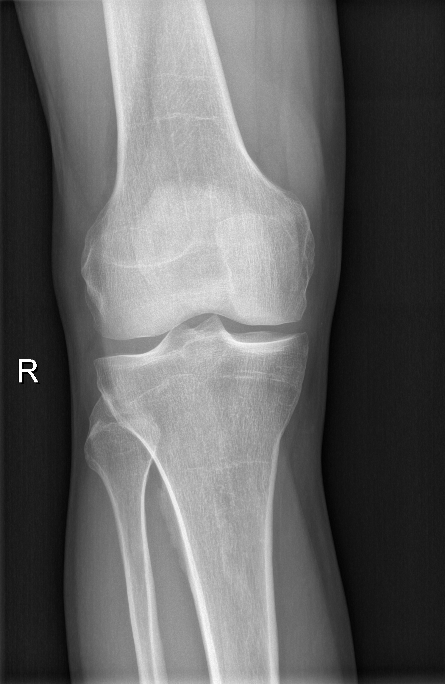 Prepatellar bursitis | Image | Radiopaedia.org