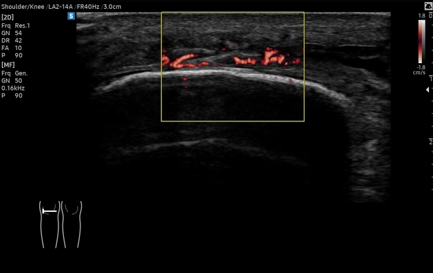 Superb microvascular imaging (ultrasound) | Radiology Reference Article ...