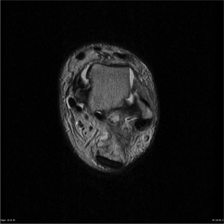 Anterior talofibular ligament (ATFL) tear - chronic | Radiology Case ...