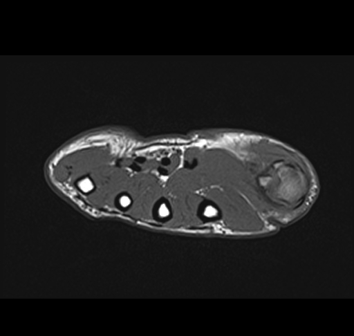 Stener Lesion Image 1124