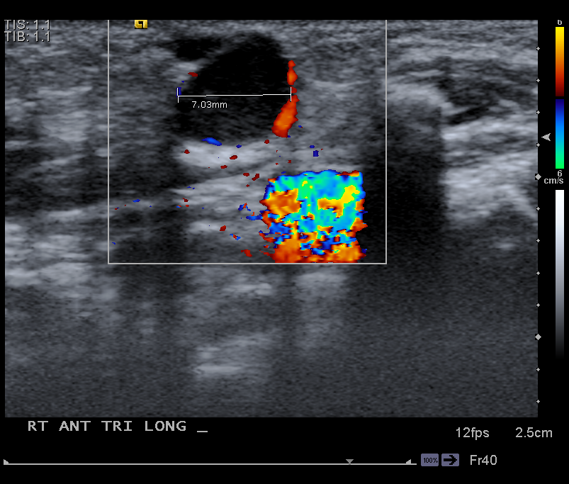 Branchial Cleft Cyst Image