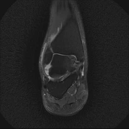 osteochondritis dissecans talus icd 10