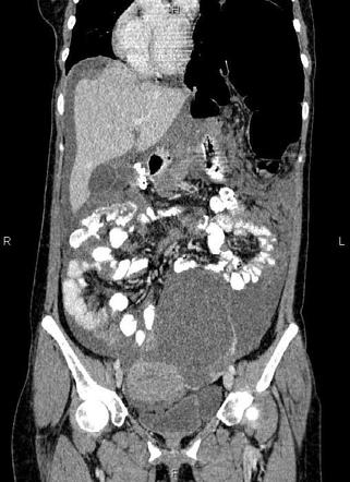 Pseudomyxoma peritonei | Image | Radiopaedia.org