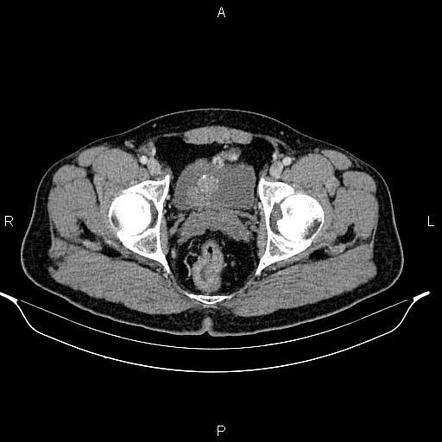 Urinary Bladder Cancer | Radiology Case | Radiopaedia.org