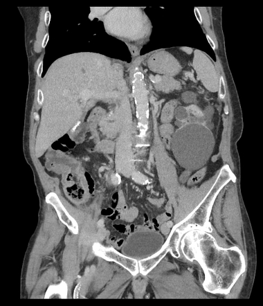 Hemorrhagic cyst in polcystic kidney (CEUS) | Image | Radiopaedia.org