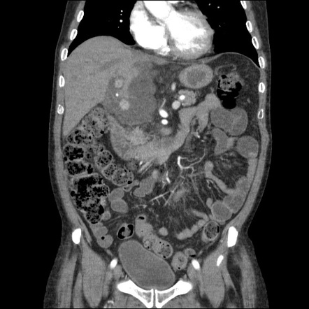 Hepatic artery stenosis | Image | Radiopaedia.org