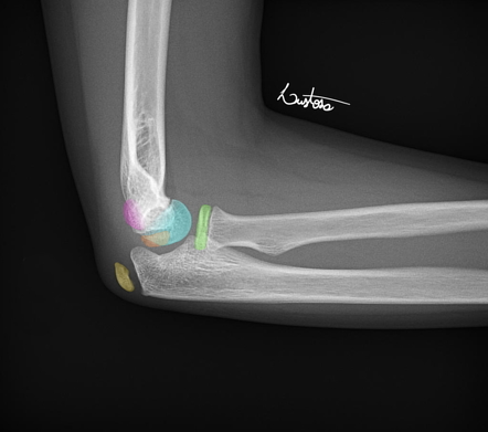 Ossification centers of the elbow | Radiology Reference Article ...