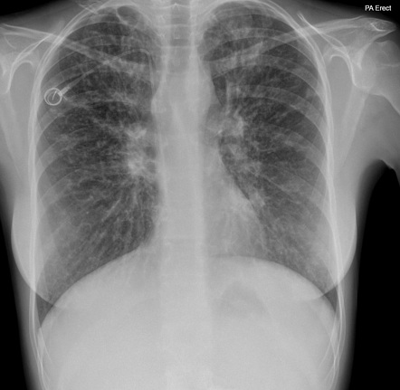 cystic fibrosis case study pubmed