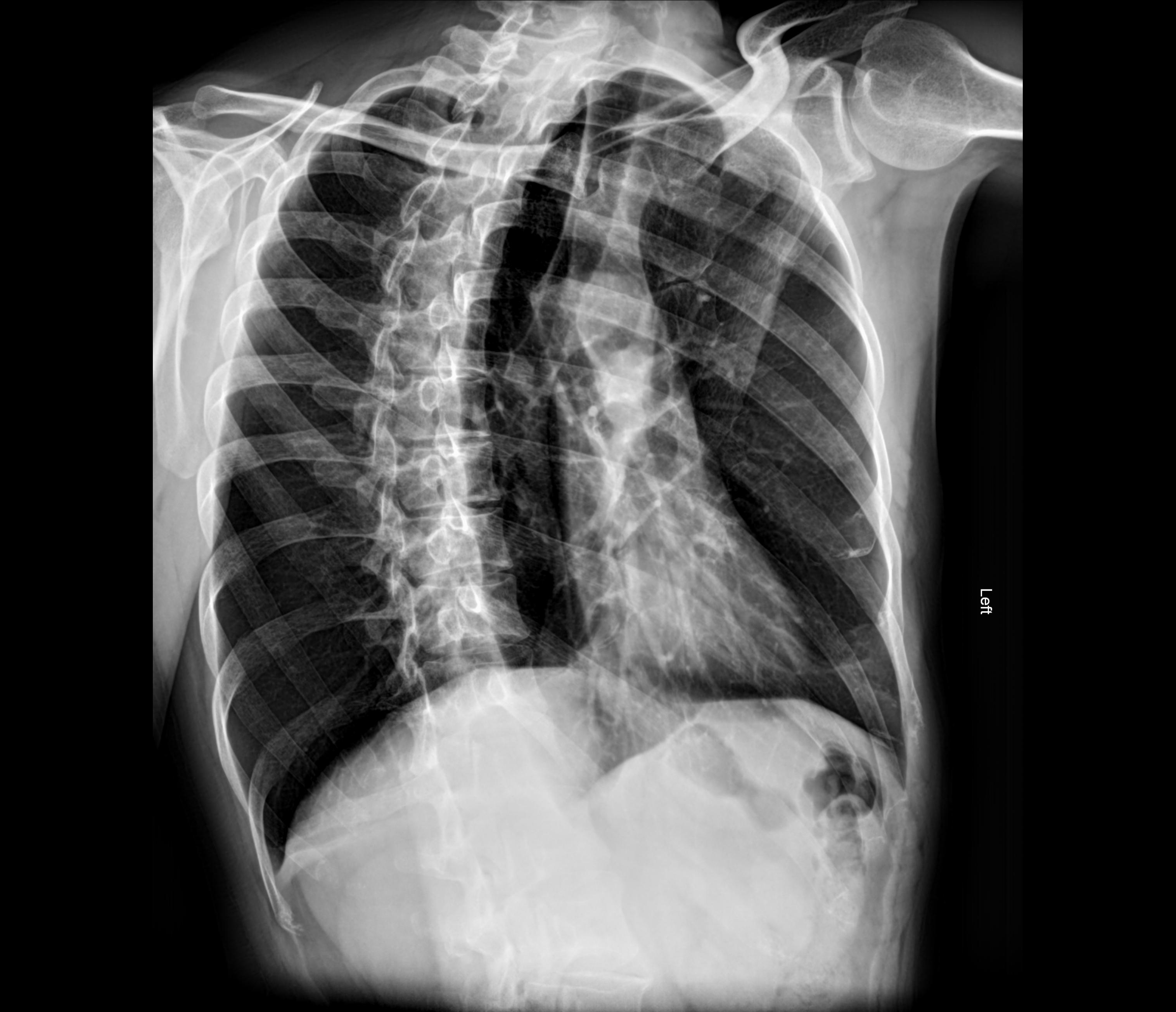 Ribs Xray Oblique at James Vann blog