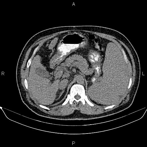 Caput medusae sign - cirrhosis | Image | Radiopaedia.org