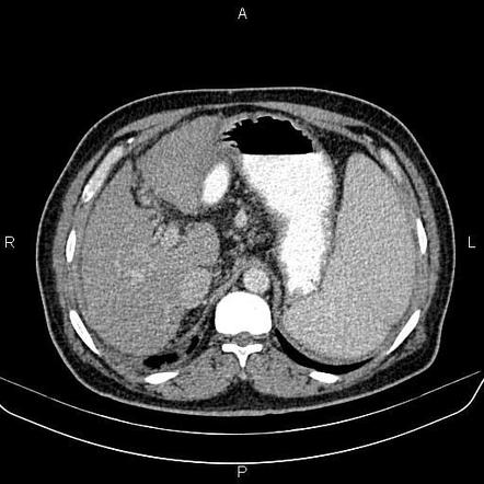 Caput medusae sign - cirrhosis | Image | Radiopaedia.org