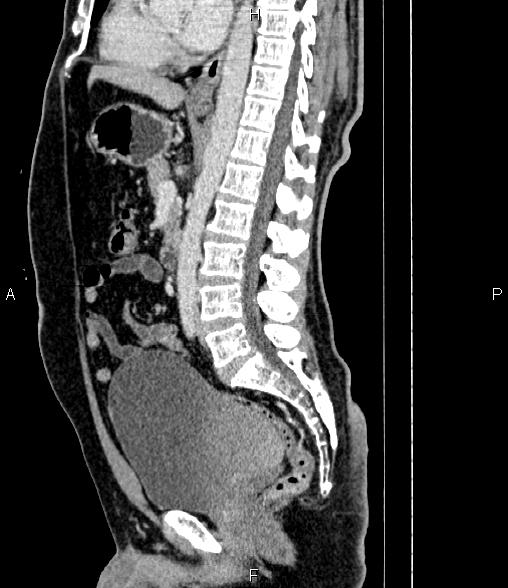 Renal cell carcinoma | Image | Radiopaedia.org