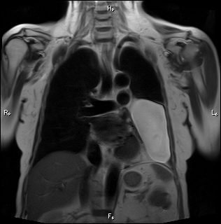 Giant pericardial cyst | Image | Radiopaedia.org