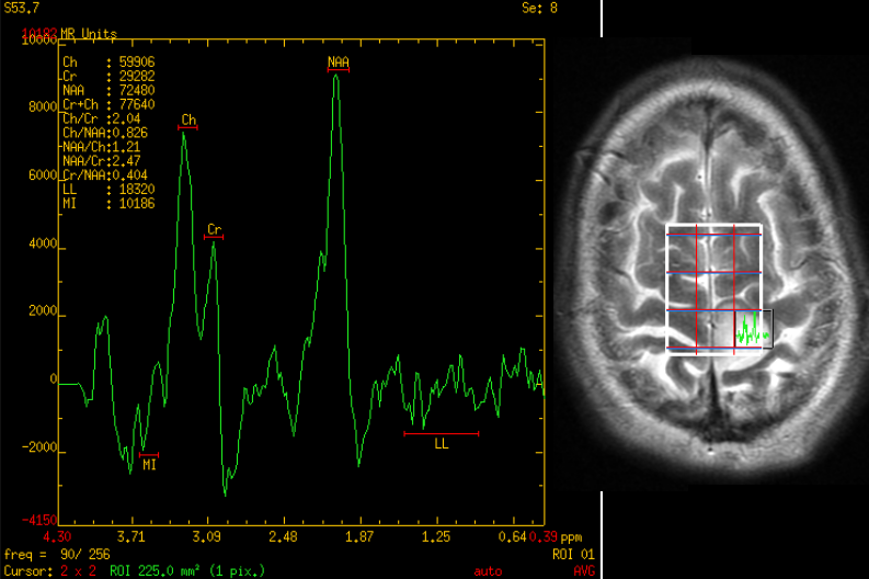 Low Grade Glioma Brain Tumor Life Expectancy