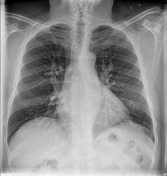 Upper lobe pulmonary venous diversion | Radiology Reference Article ...