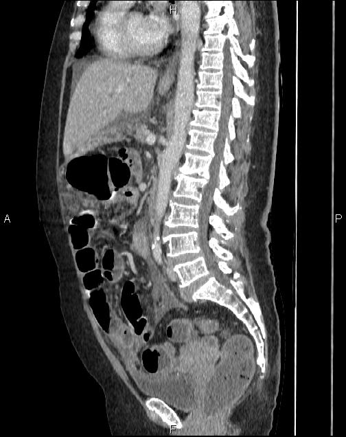 Omental cake from ovarian cancer | Image | Radiopaedia.org