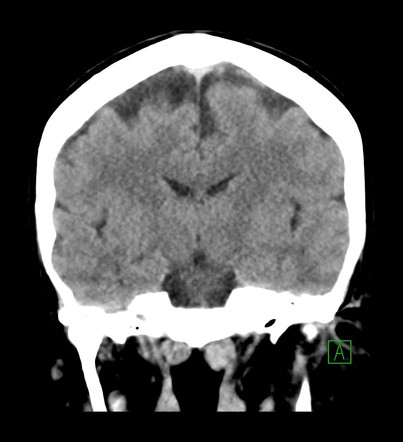 Choroid plexus xanthogranuloma | Image | Radiopaedia.org