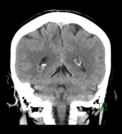 Choroid plexus xanthogranuloma | Radiology Case | Radiopaedia.org