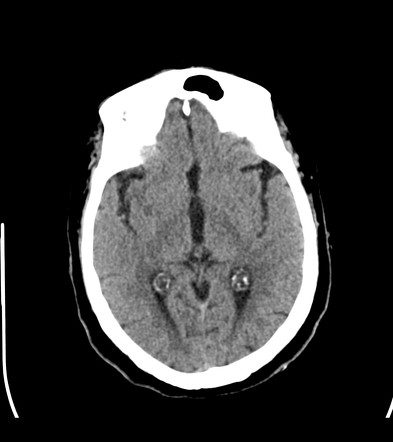 Choroid plexus xanthogranuloma | Radiology Case | Radiopaedia.org