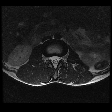 Spinal ependymoma | Image | Radiopaedia.org