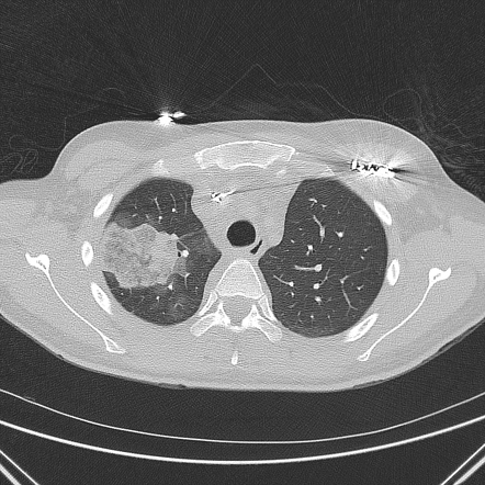 Pulmonary infarction | Radiology Case | Radiopaedia.org