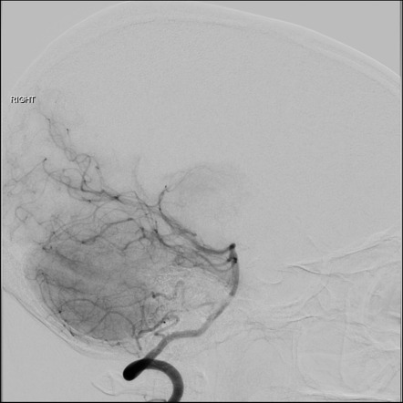 Jugular venous reflux mimicking dural AVF | Image | Radiopaedia.org