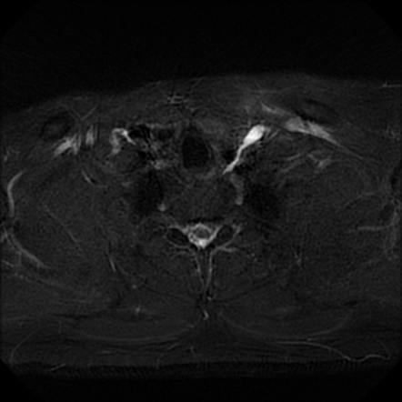 Thoracic Duct Radiology Reference Article Radiopaedia Org