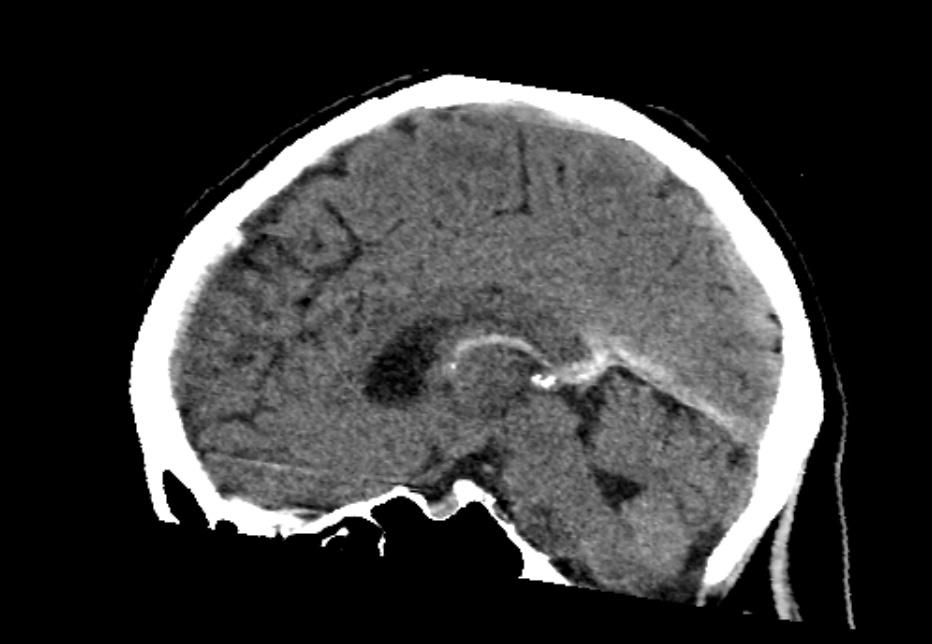 Venous Infarction Due To Deep Cerebral Venous Thrombosis Image