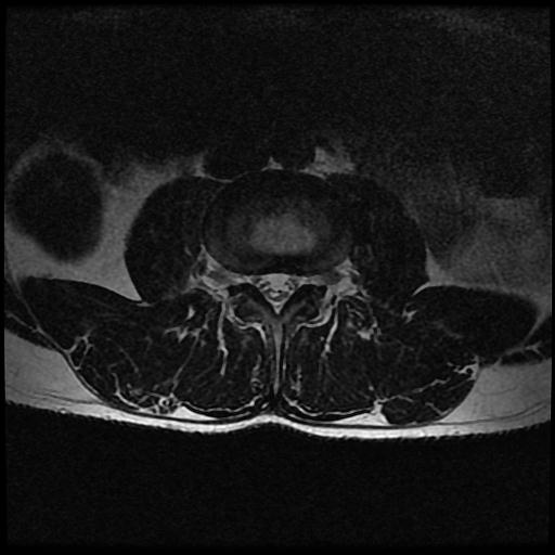 Vertebral body compression fracture - L2 | Image | Radiopaedia.org