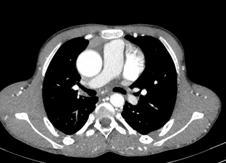 Aortic Coarctation With Thrombosis 